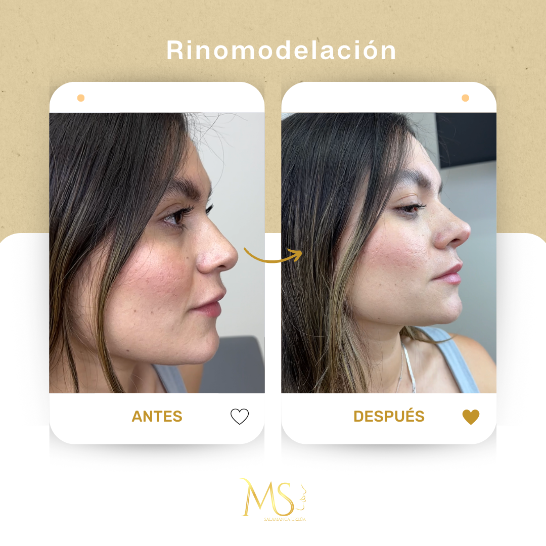 Resultado de rinoplastia - antes y después