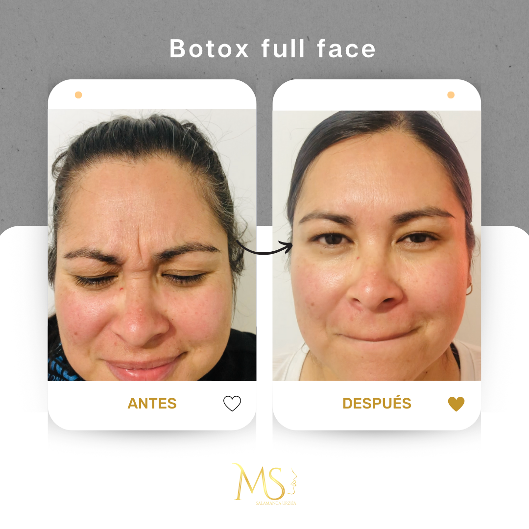 Resultado de aumento de pecho - antes y después