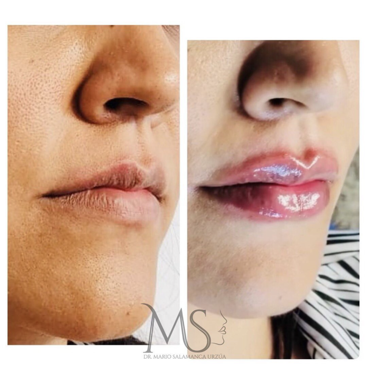 Relleno de labios: antes y después