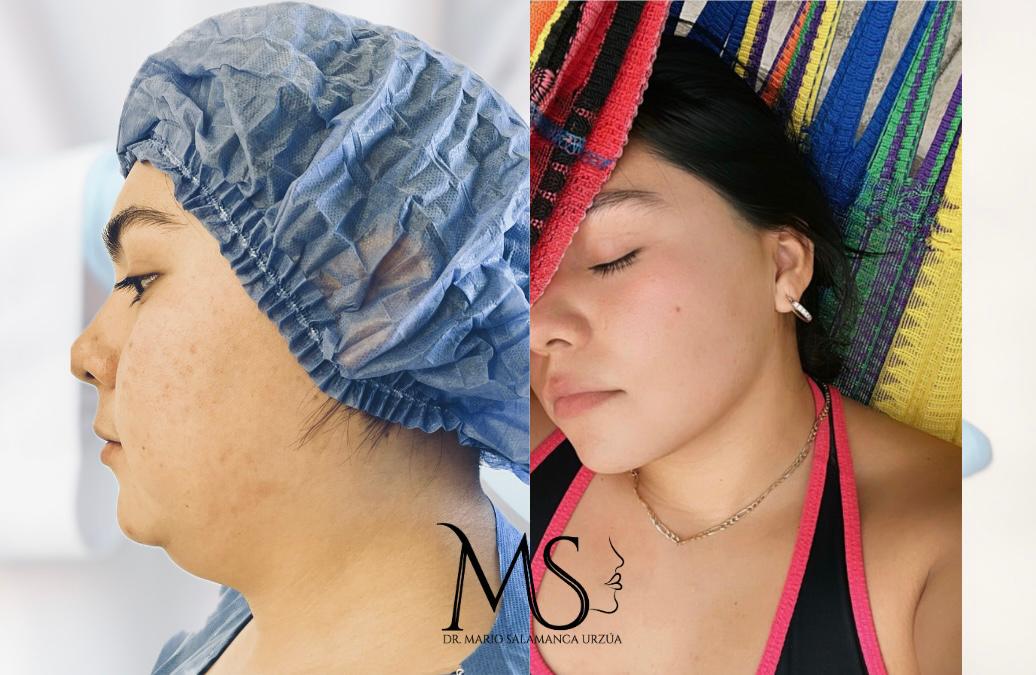 otoplastia reconstructiva