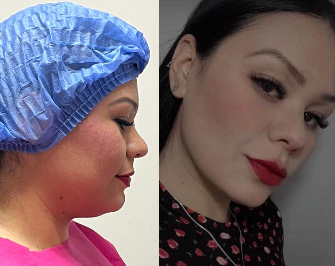 otoplastia reconstructiva