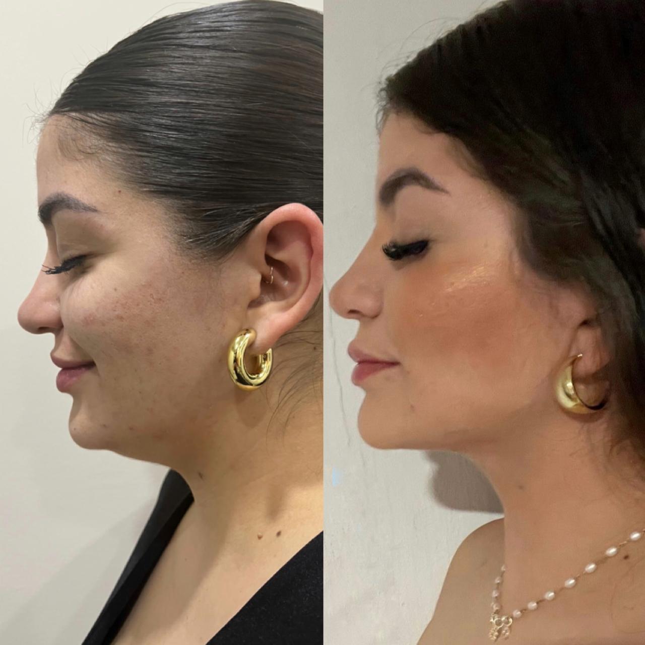 otoplastia reconstructiva