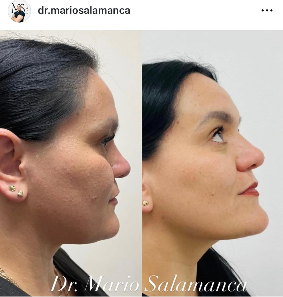 otoplastia reconstructiva