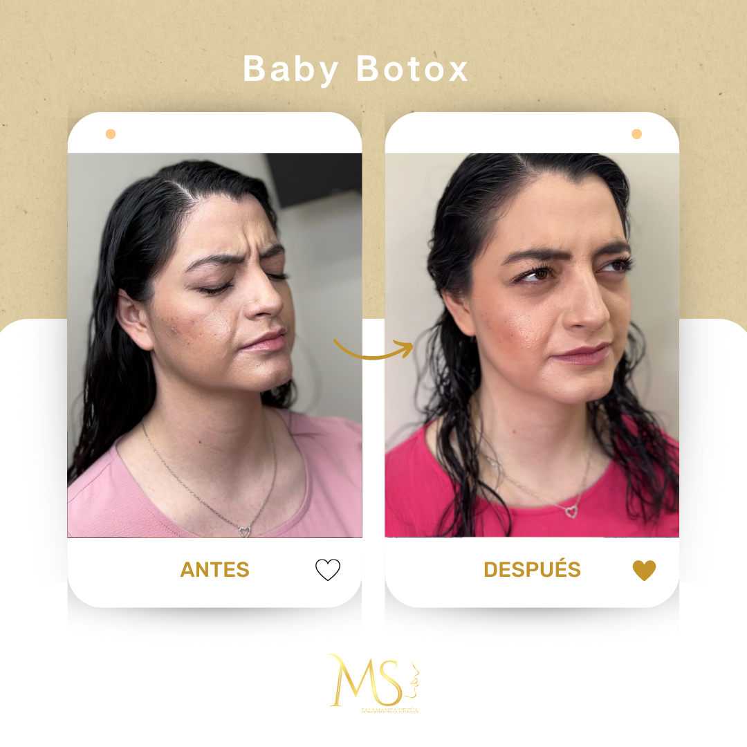 Botox: antes y después